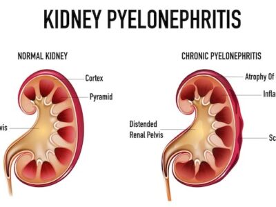 KIDNEY INFECTIONS- CAUSES AND SYMPTOMS